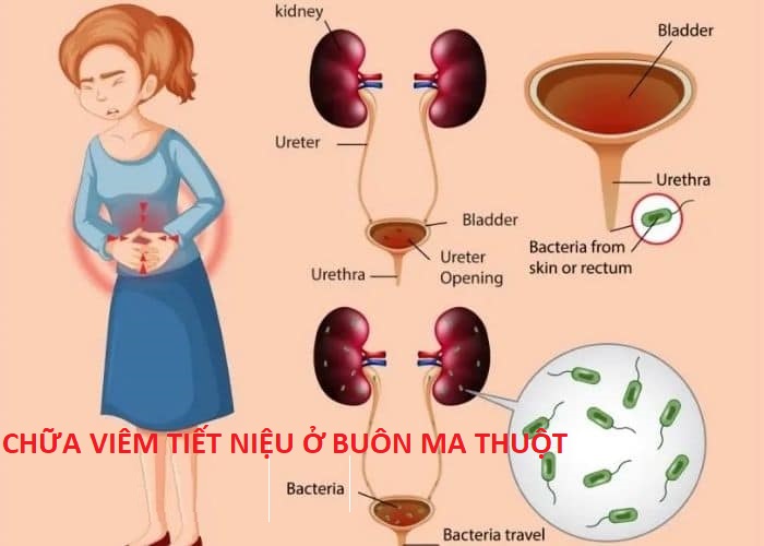 Chữa viêm tiết niệu ở Buôn Ma Thuột